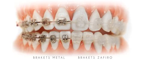 brackets de zafiro vs metalicos|brackets de zafiro metal.